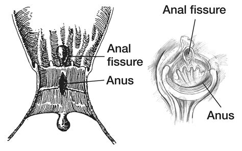 HOLE ANAL